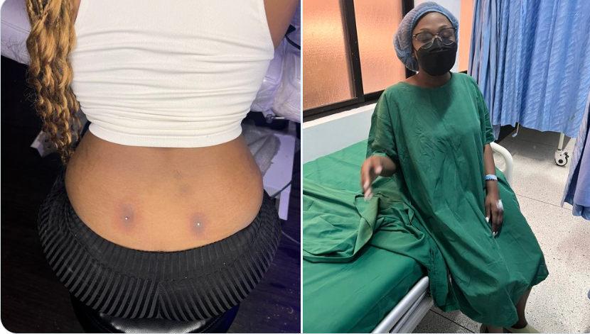 Lady lands in the hospital after getting a back dimple piercing